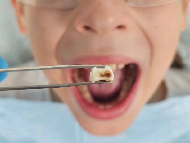 Best Urgent Care for Lost Fillings or Crowns in Ferndale, WA